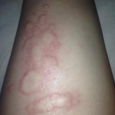 Schon Seit Einer Woche Nesselsucht Und Es Geht Nicht Weg Hilfe Bitte Korper Krankheit Brennen Schon Seit Einer Woche Nesselsucht Und Es Geht Nicht Weg Hilfe Bitte Korper Krankheit Brennen