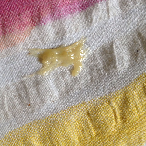 Schon Wieder Eitrige Bronchien Infektion Auswurf Schon Wieder Eitrige Bronchien Infektion Auswurf