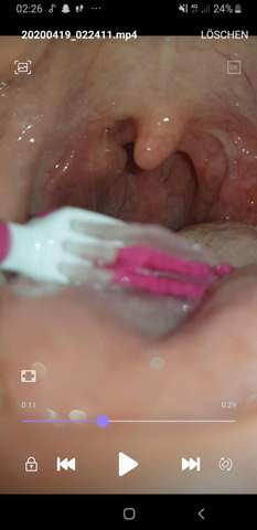 Schon Wieder Eitrige Mandelentzundung Gesundheit Und Medizin Gesundheit Krankheit Schon Wieder Eitrige Mandelentzundung Gesundheit Und Medizin Gesundheit Krankheit