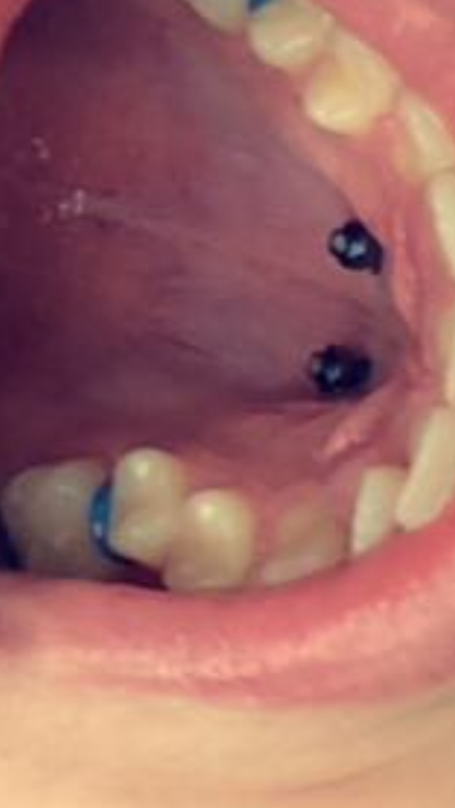 Schrauben Im Mund Wieso Braucht Man Das Fur Eine Zahnspange Gesundheit Und Medizin Medizin Arzt Schrauben Im Mund Wieso Braucht Man Das Fur Eine Zahnspange Gesundheit Und Medizin Medizin Arzt