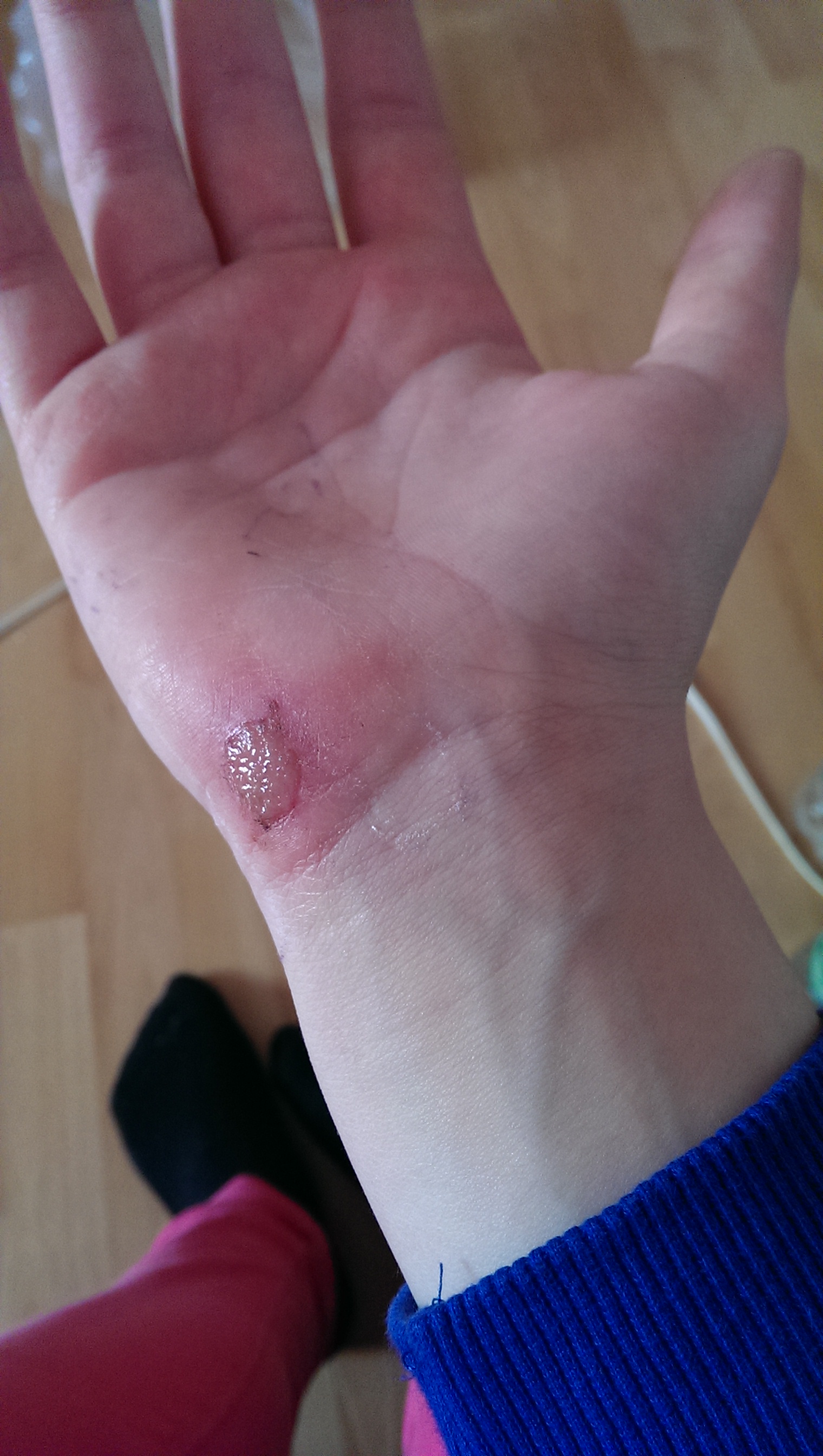 schürfwunde schlimm? (Gesundheit, Arzt, Verletzung)