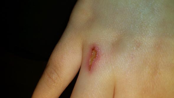 Schürfwunde entzündet? Wann setzt Heilung ein? Komische Wunde (Arzt, Entzündung)