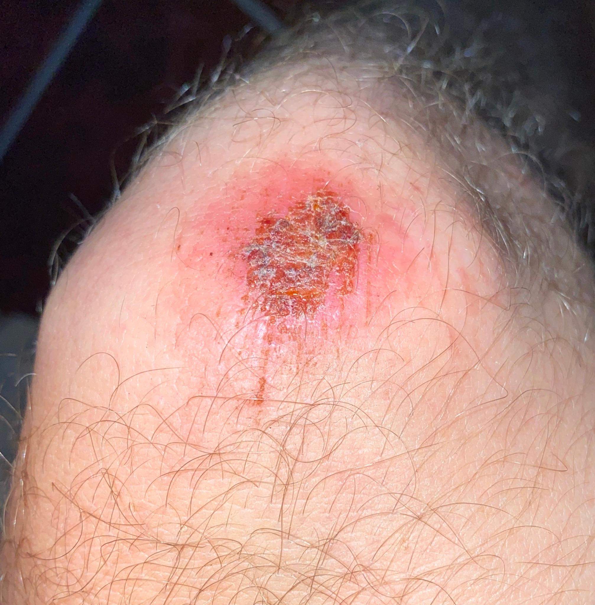 Schürfwunde gerötet/rosa? (Gesundheit und Medizin, Gesundheit, Medizin)