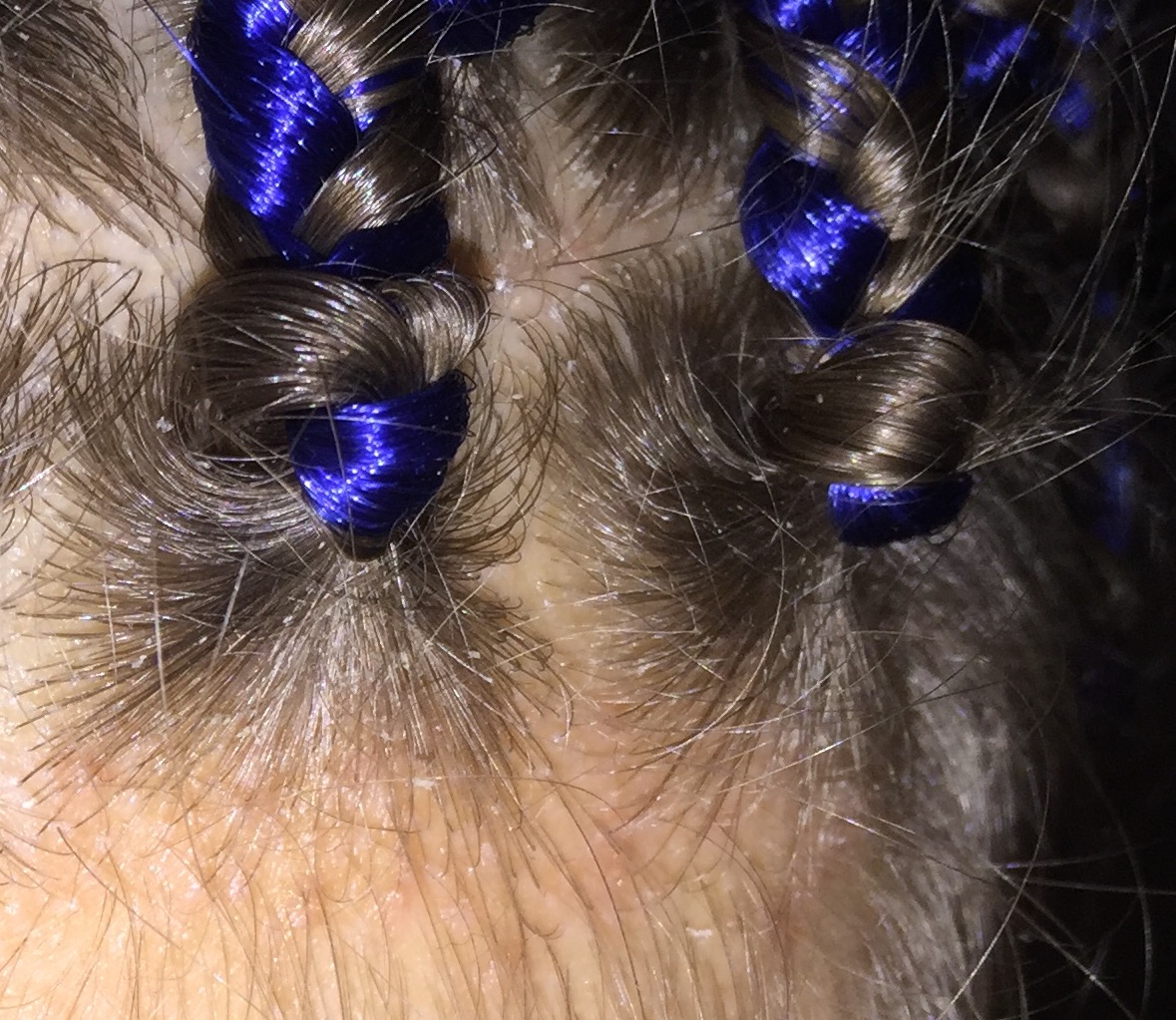 Schuppen Bei Rastazopfen Was Kann Man Tun Haare Tipps Pflege