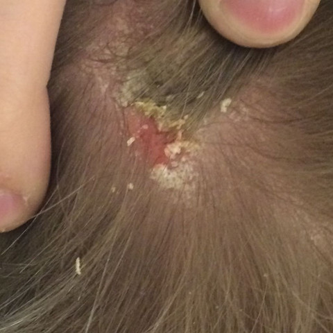 Schuppen Was Ist Das Haare Kopf Schuppen Was Ist Das Haare Kopf