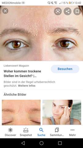 Schuppige Augenbraue Wimper Gesundheit Und Medizin Beauty Augenbrauen Schuppige Augenbraue Wimper Gesundheit Und Medizin Beauty Augenbrauen