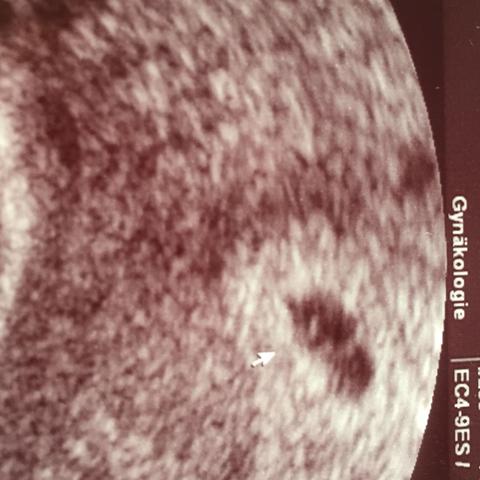 Ultraschallbild von der 6+5. Schwangerschaftswoche - (Gesundheit, schwanger, Ultraschall)