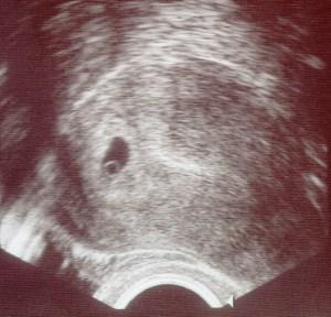 Schwanger Laut Urin Ja Aber Blut Sagt Nein Schwanger Laut Urin Ja Aber Blut Sagt Nein