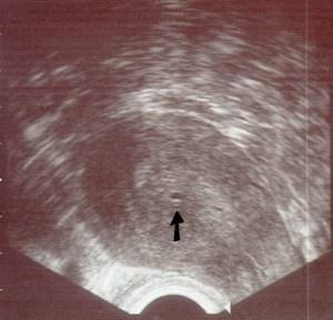 Schwanger Laut Urin Ja Aber Blut Sagt Nein Schwanger Laut Urin Ja Aber Blut Sagt Nein