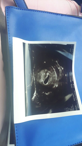 Ultraschall ca.5.SSW. - (Schwangerschaft, Baby, Frauenarzt)