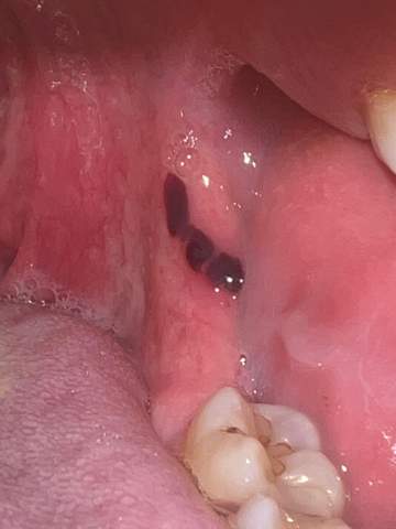 Schwarze Flecken im Mund Bluterguss?