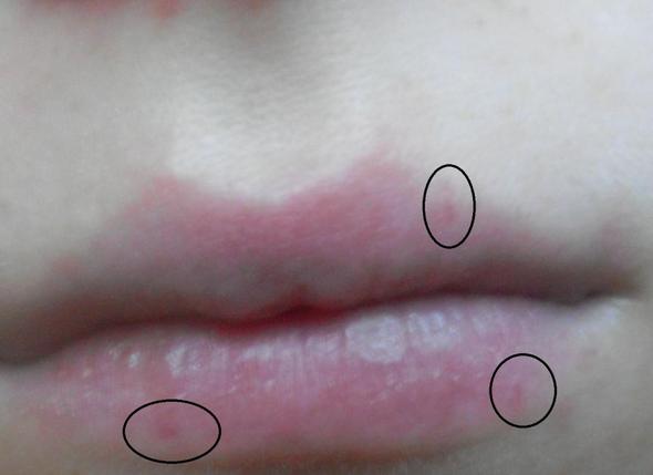 Schwarze Mitesser Am Lippenrand Gehen Nicht Weg Beauty Pickel Hautpflege