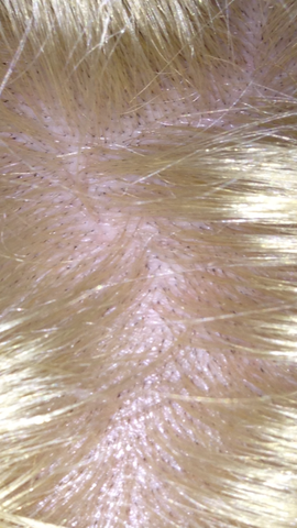 Schwarze Punkte Auf Dem Kopf Haut Kopfhaut