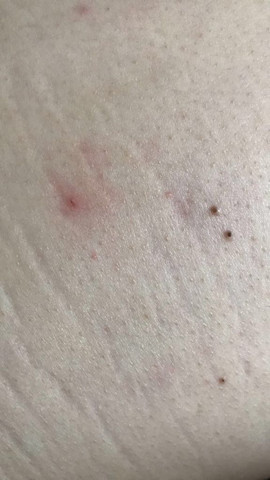 Schwarze Punkte Auf Dem Rucken Schwarz Entfernen Schwarze Punkte Auf Dem Rucken Schwarz Entfernen