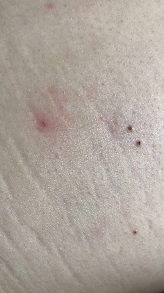 Schwarze Punkte auf dem rücken? (schwarz, entfernen)
