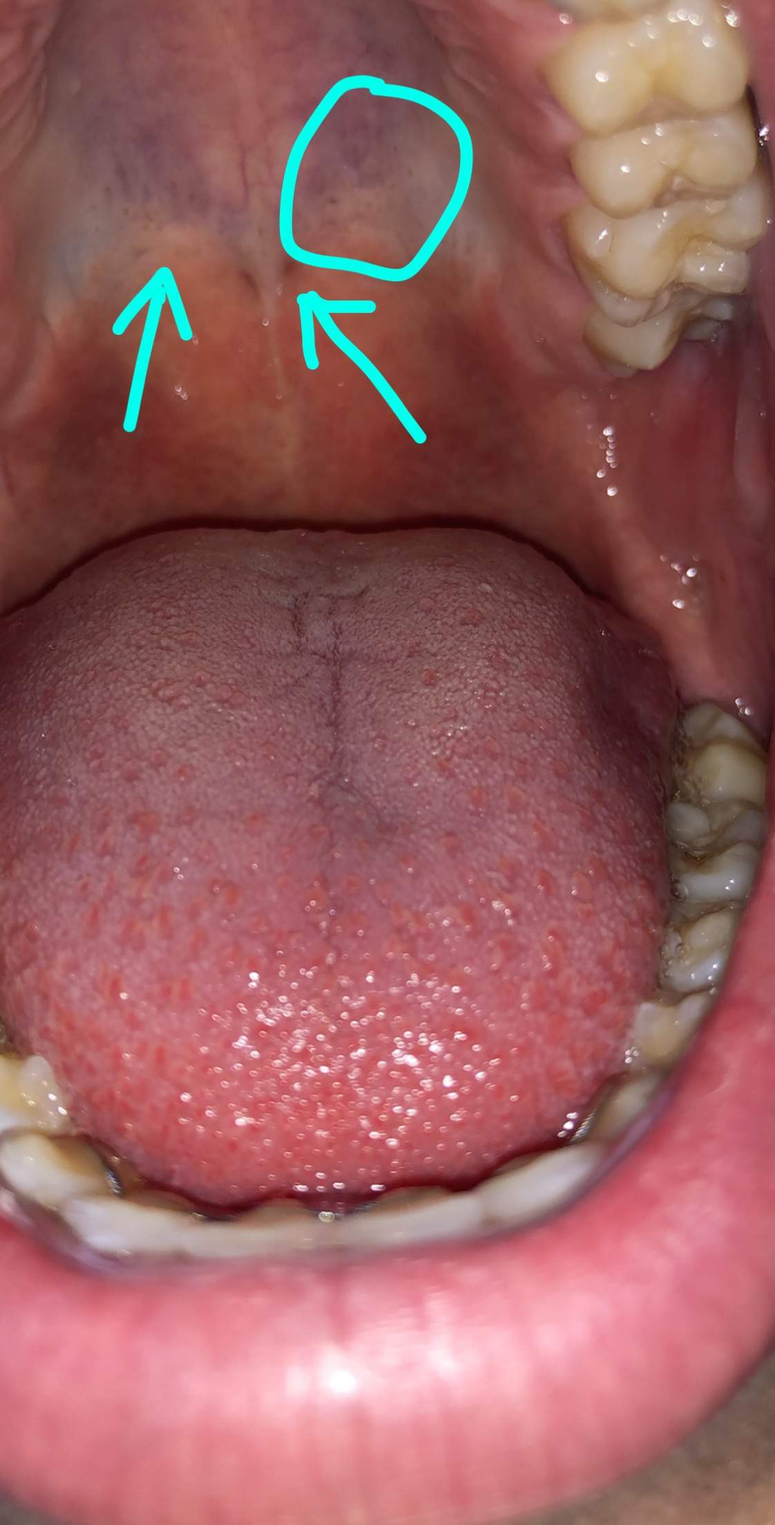Schwarze punkte in Mundhöle? (Gesundheit und Medizin, Gesundheit, Mund)