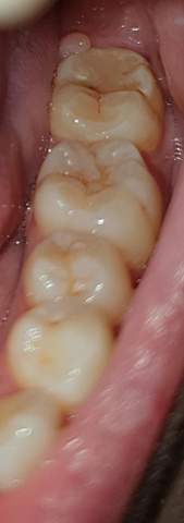 Schwarze Punkte Und Braune Stellen Auf Den Zahnen Zahnpflege Karies