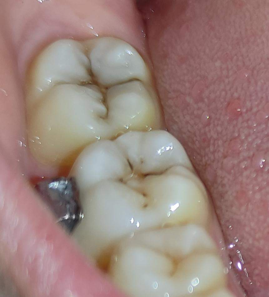 Schwarze Risse im Zahn (Achtung Bild)? (Gesundheit und Medizin ...