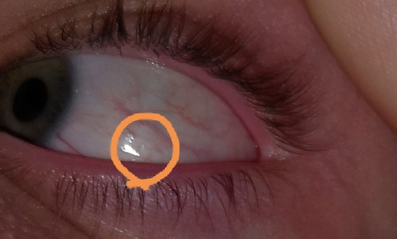 Schwarze Stelle Im Auge Arzt Angst Augen Schwarze Stelle Im Auge Arzt Angst Augen