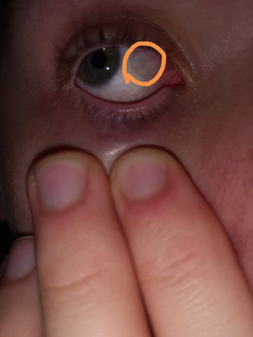 Schwarze Stelle Im Auge Arzt Angst Augen Schwarze Stelle Im Auge Arzt Angst Augen