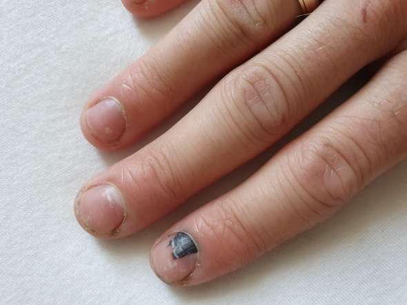 Schwarze Stelle Unter Fingernagel Gesundheit Verletzung Fingernagel Schwarze Stelle Unter Fingernagel Gesundheit Verletzung Fingernagel