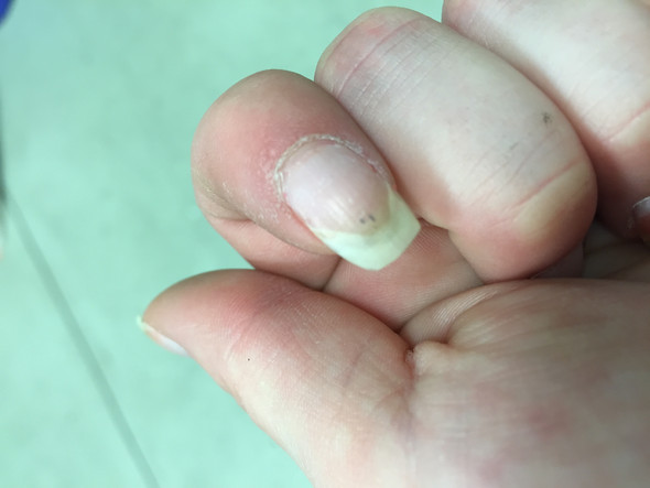 Schwarze Striche Unter Dem Fingernagel Soll Ich Zum Arzt Gesundheit Nagel Schwarze Striche Unter Dem Fingernagel Soll Ich Zum Arzt Gesundheit Nagel