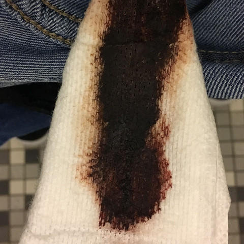Schwarzer Ausfluss Hilfe Arzt Krankheit Schwarzer Ausfluss Hilfe Arzt Krankheit