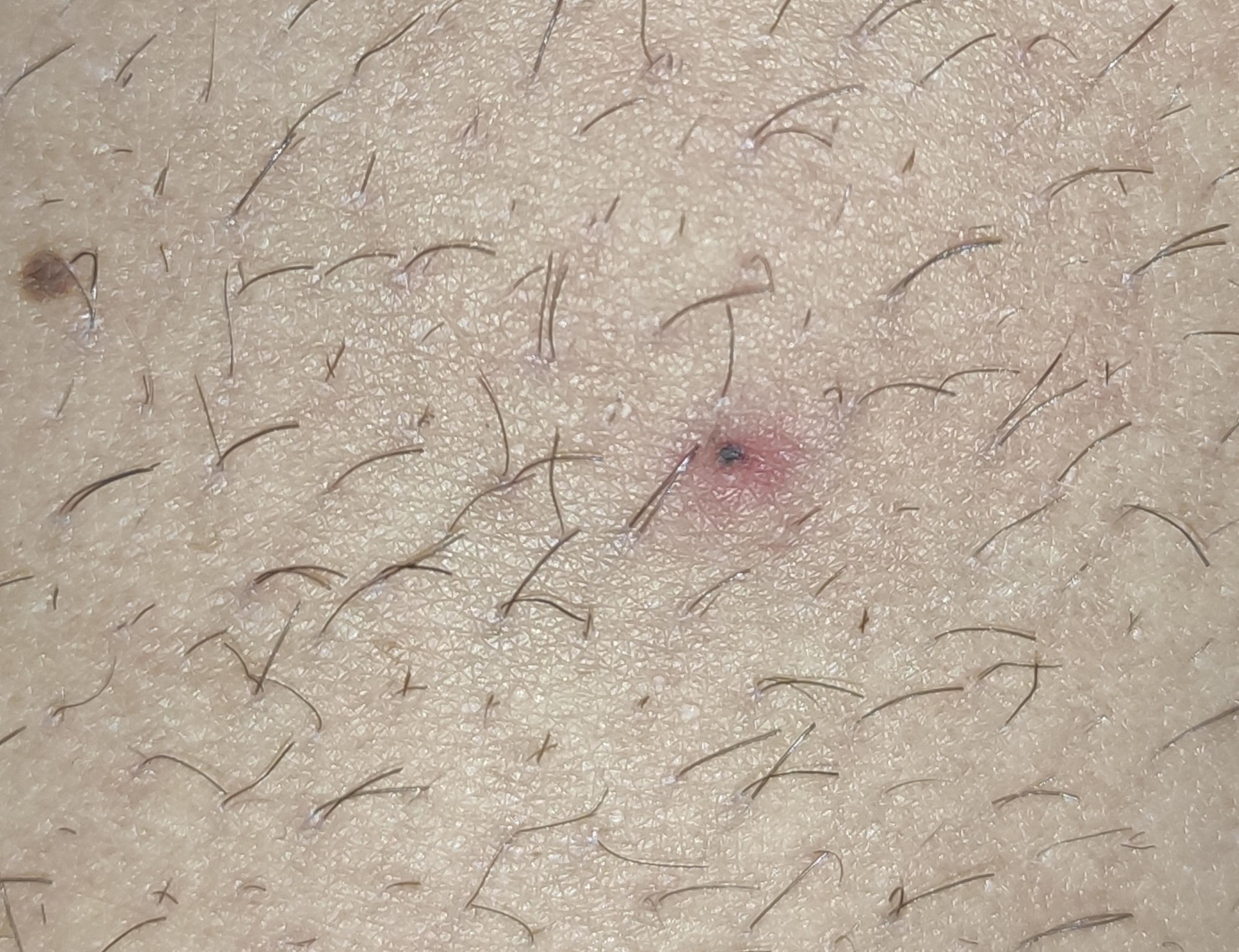 schwarzer fleck gesundheit und