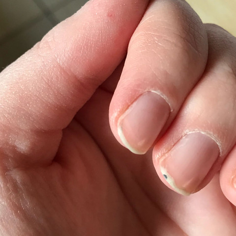 Bild von meinem Fingernagel  - (Gesundheit und Medizin, Haut, Flecken)