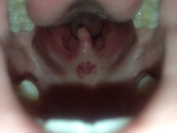 Schwarzer Fleck am Gaumen und rote Punkte im Mund