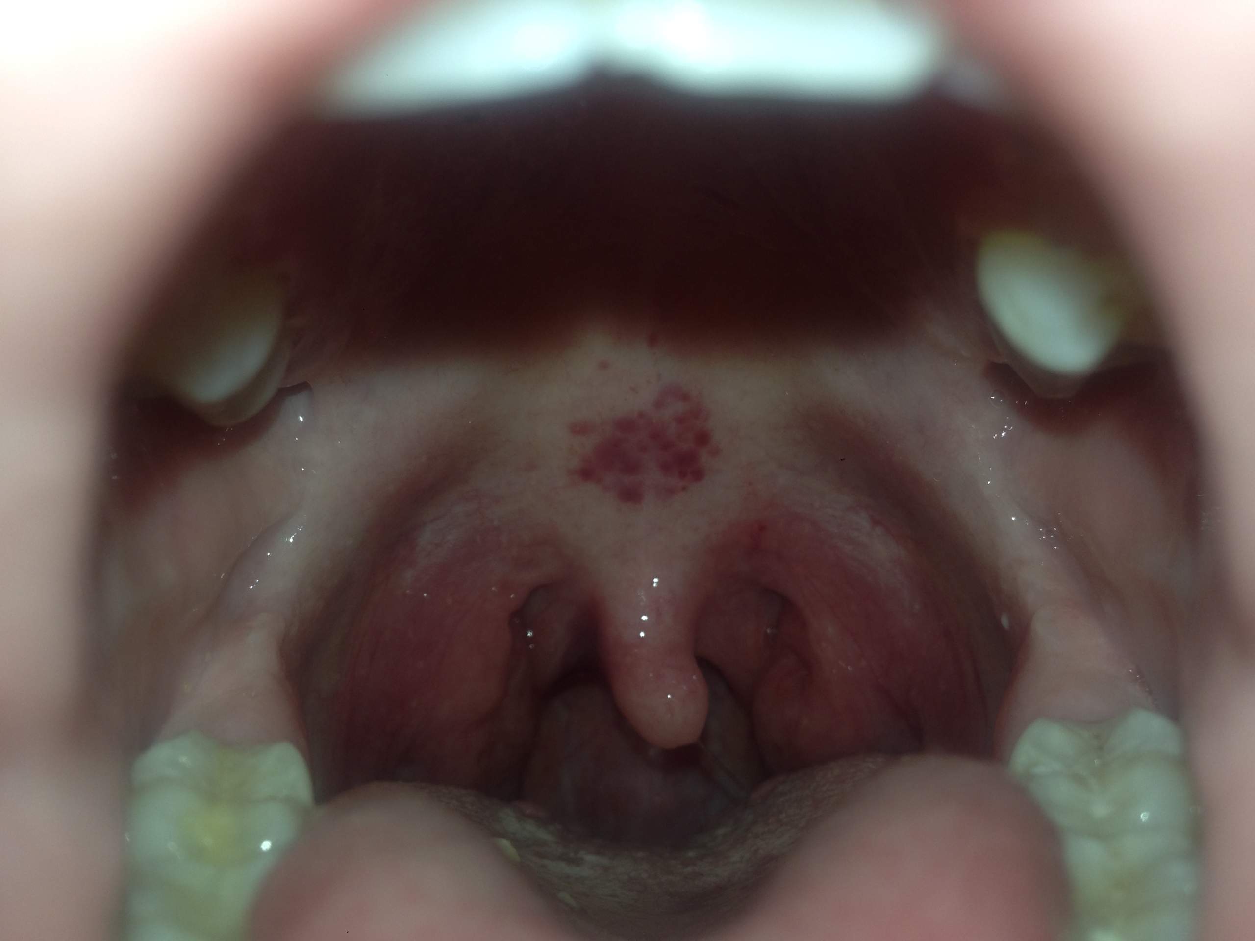 Schwarzer Fleck am gaumen und rote Punkte im Mund? (Gesundheit und