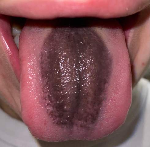 Schwarzer Fleck Auf Der Zunge Gesundheit Und Medizin Gesundheit Krankheit Schwarzer Fleck Auf Der Zunge Gesundheit Und Medizin Gesundheit Krankheit