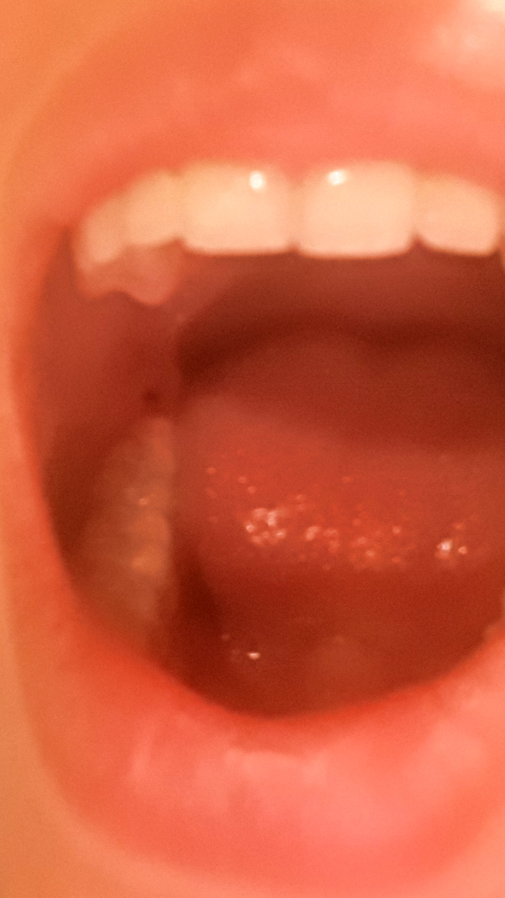 Schwarzer Fleck hinter rechtem Backenzahn? (Arzt, Krankheit, Zähne) Schwarzer Fleck hinter rechtem Backenzahn? (Arzt, Krankheit, Zähne)