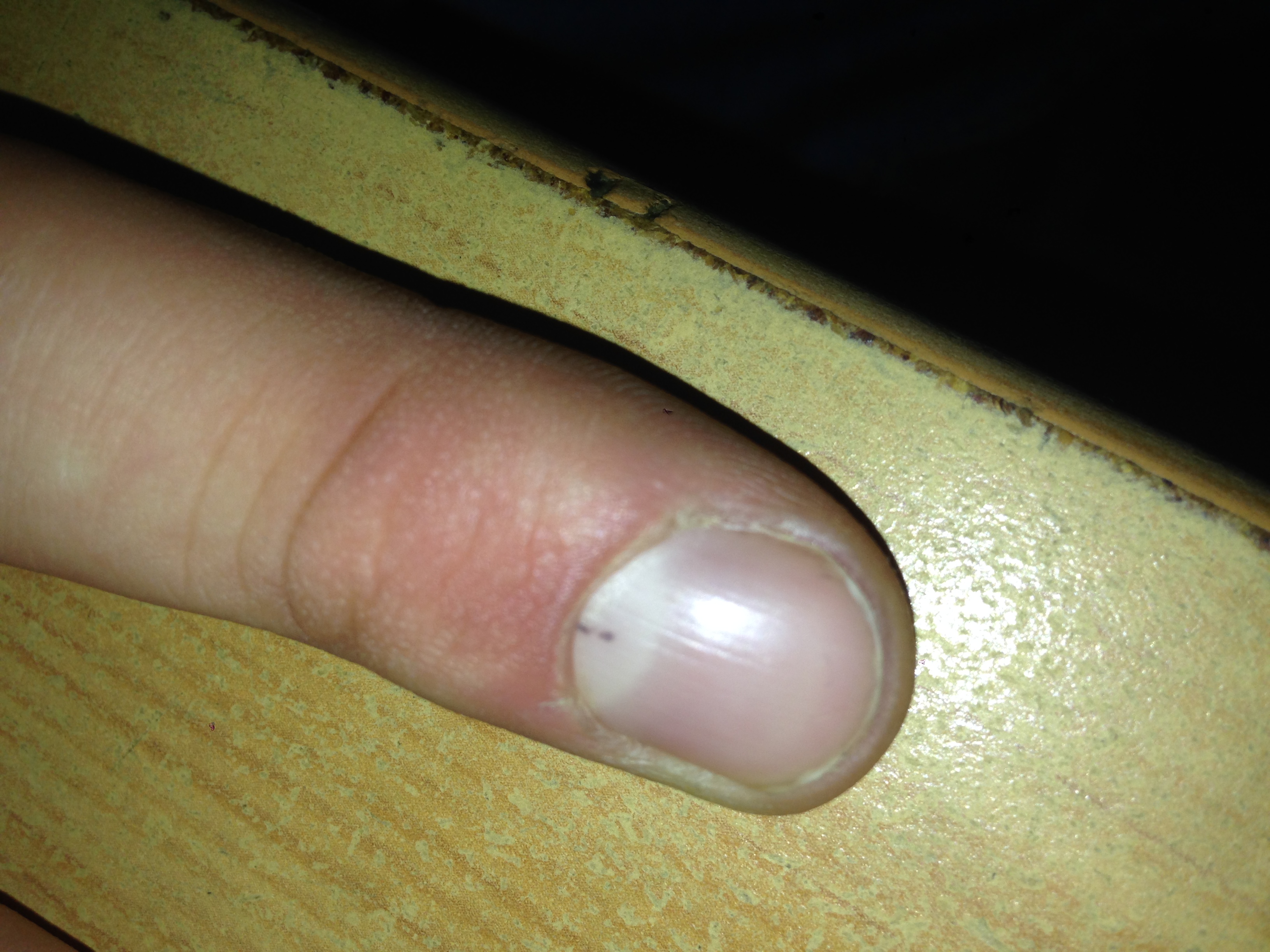 Schwarzer Fleck und Strich im Nagelbett (Gesundheit, Haut, Krebs)