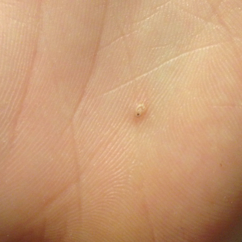Schwarzer Fleck unter der Haut? (krank, Flecken, Warzen)