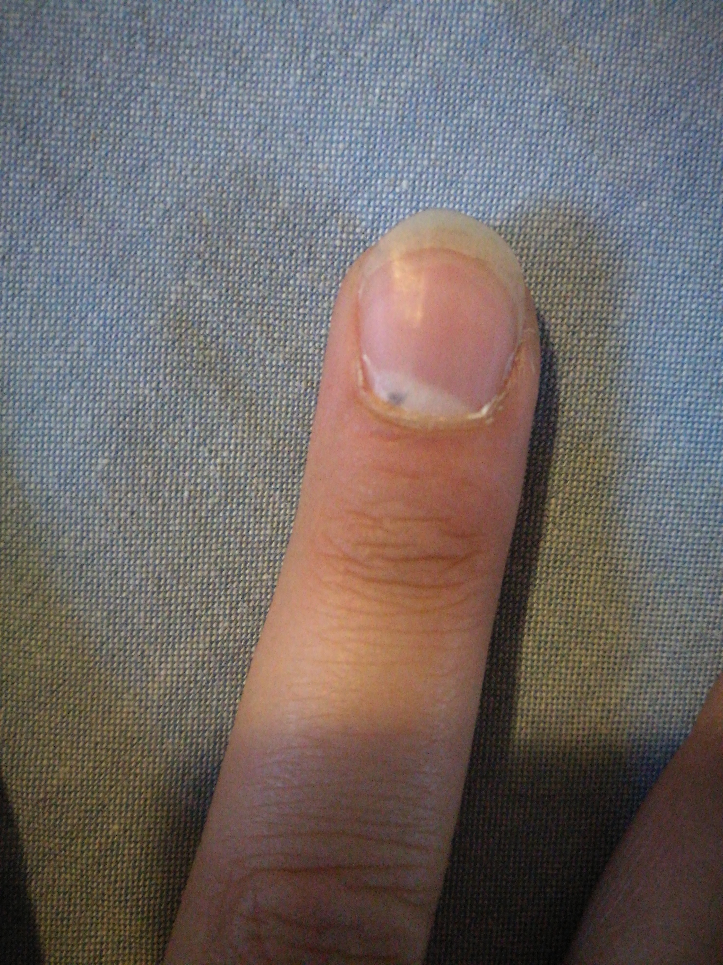 Schwarzer Fleck unter meinem Nagel was könnte das sein? (Gesundheit