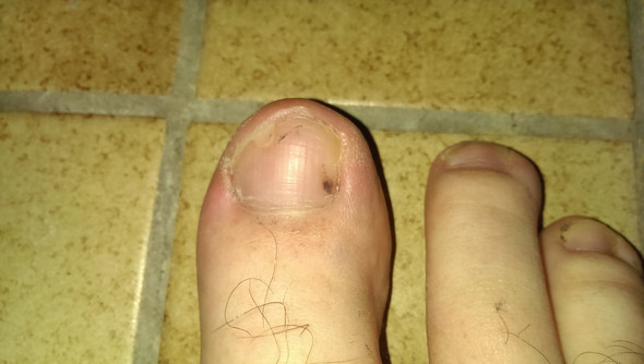 Schwarzer Fleck Unter Zehnagel Medizin Haut Krebs Schwarzer Fleck Unter Zehnagel Medizin Haut Krebs