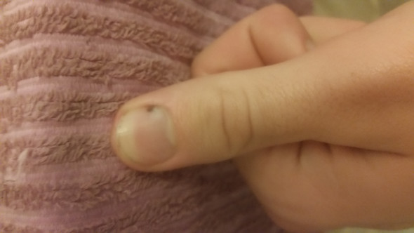 Schwarzer Fleck Unterm Fingernagel Bild Finger Fingernagel Schwarzer Fleck Unterm Fingernagel Bild Finger Fingernagel