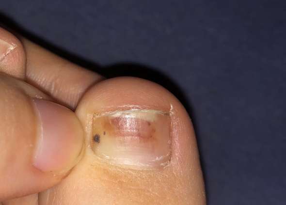 schwarzer hautkrebs oder nagelpilz gesundheit und medizin gesundheit haut