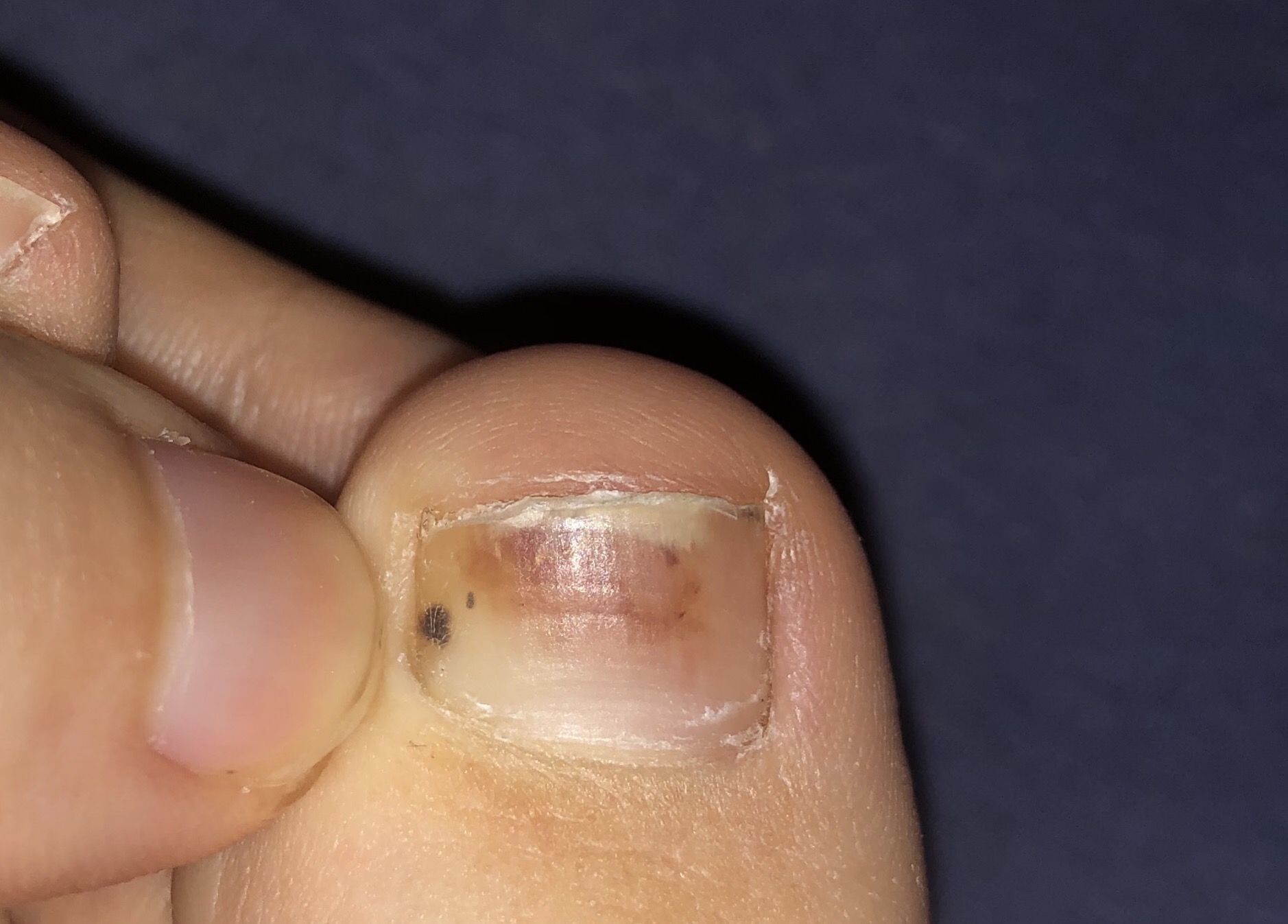 Schwarzer Hautkrebs Oder Nagelpilz Gesundheit Und Medizin Gesundheit Haut Schwarzer Hautkrebs Oder Nagelpilz Gesundheit Und Medizin Gesundheit Haut