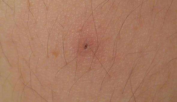 Schwarzer Kleiner Punkt Auf Arm Entzundet Was Ist Das Gesundheit Medizin Haare Schwarzer Kleiner Punkt Auf Arm Entzundet Was Ist Das Gesundheit Medizin Haare