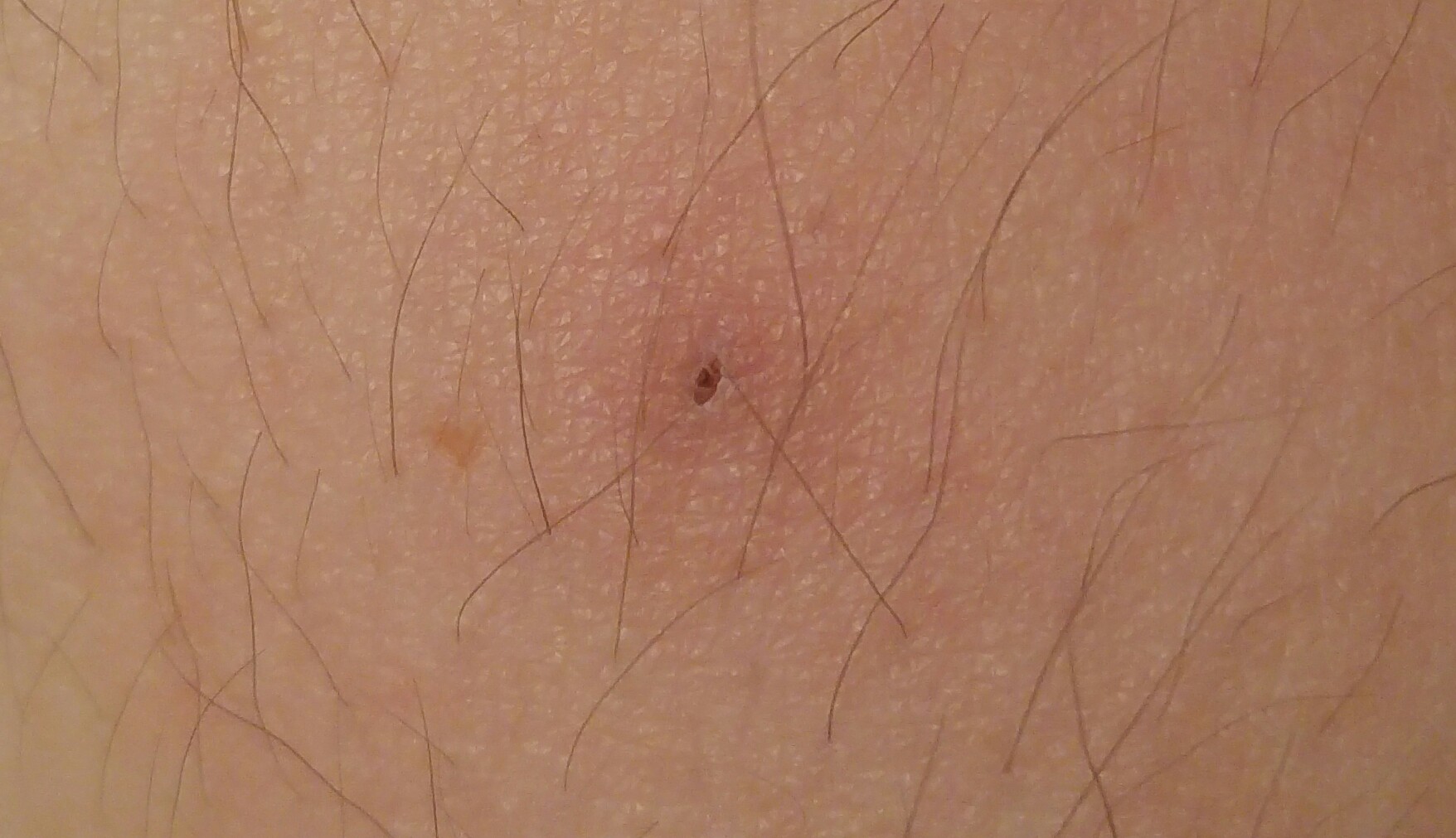 Schwarzer kleiner Punkt auf Arm entzündet, was ist das? (Gesundheit, Haare, Medizin) Schwarzer kleiner Punkt auf Arm entzündet, was ist das? (Gesundheit, Haare, Medizin)
