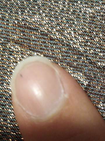 schwarzer kleiner strich im nagel vom zeigefinger gefahrlich nagel
