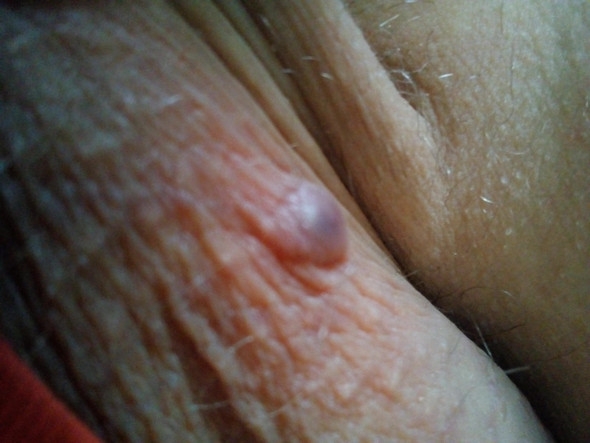 Schwarzer Pickel Am Hoden Hautkrebs Bitte Antworten Hab Echt Angst Gesundheit Und Medizin Krebs Schwarzer Pickel Am Hoden Hautkrebs Bitte Antworten Hab Echt Angst Gesundheit Und Medizin Krebs