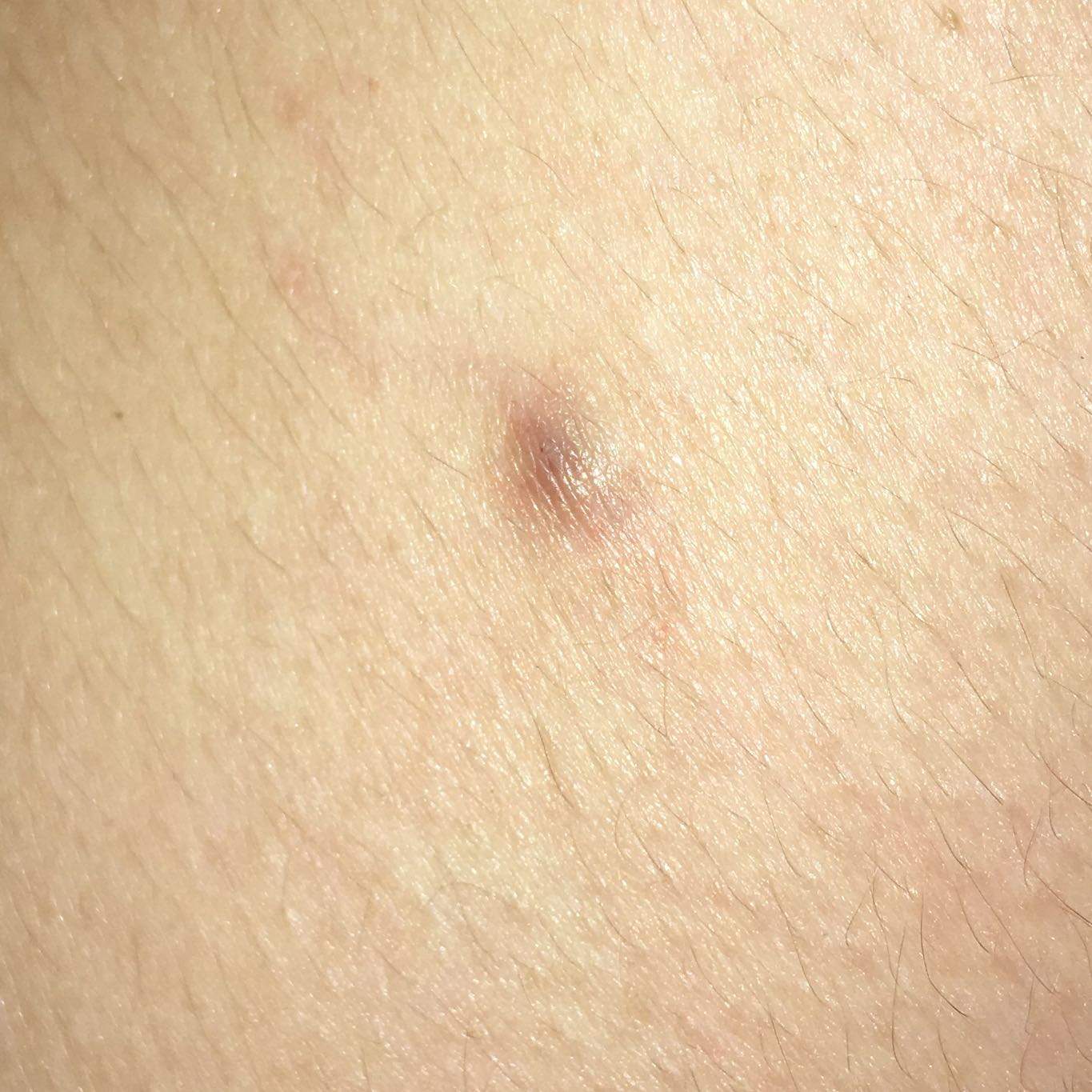 pickel am rücken ursache mann pickel am rücken ursache mann