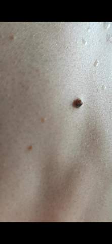 Schwarzer Pickel Kein Muttermal Auf Dem Rucken Was Konnte Es Sein Konnt Ihr Weiterhelfen Haut Schwarzer Pickel Kein Muttermal Auf Dem Rucken Was Konnte Es Sein Konnt Ihr Weiterhelfen Haut