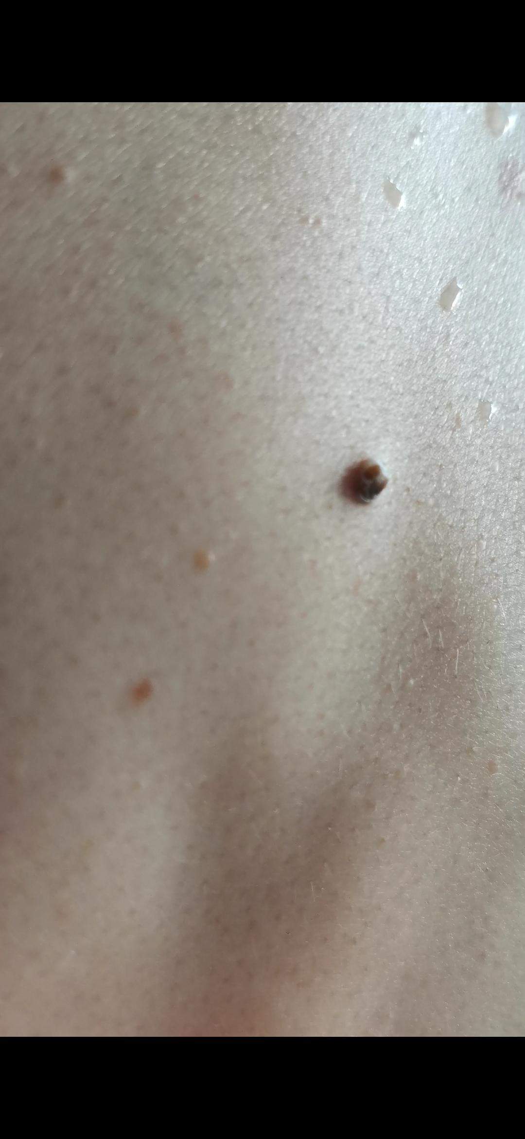 Schwarzer Pickel (kein Muttermal) auf dem Rücken. Was könnte es sein? könnt ihr weiterhelfen? (Haut) pickel auf dem rücken