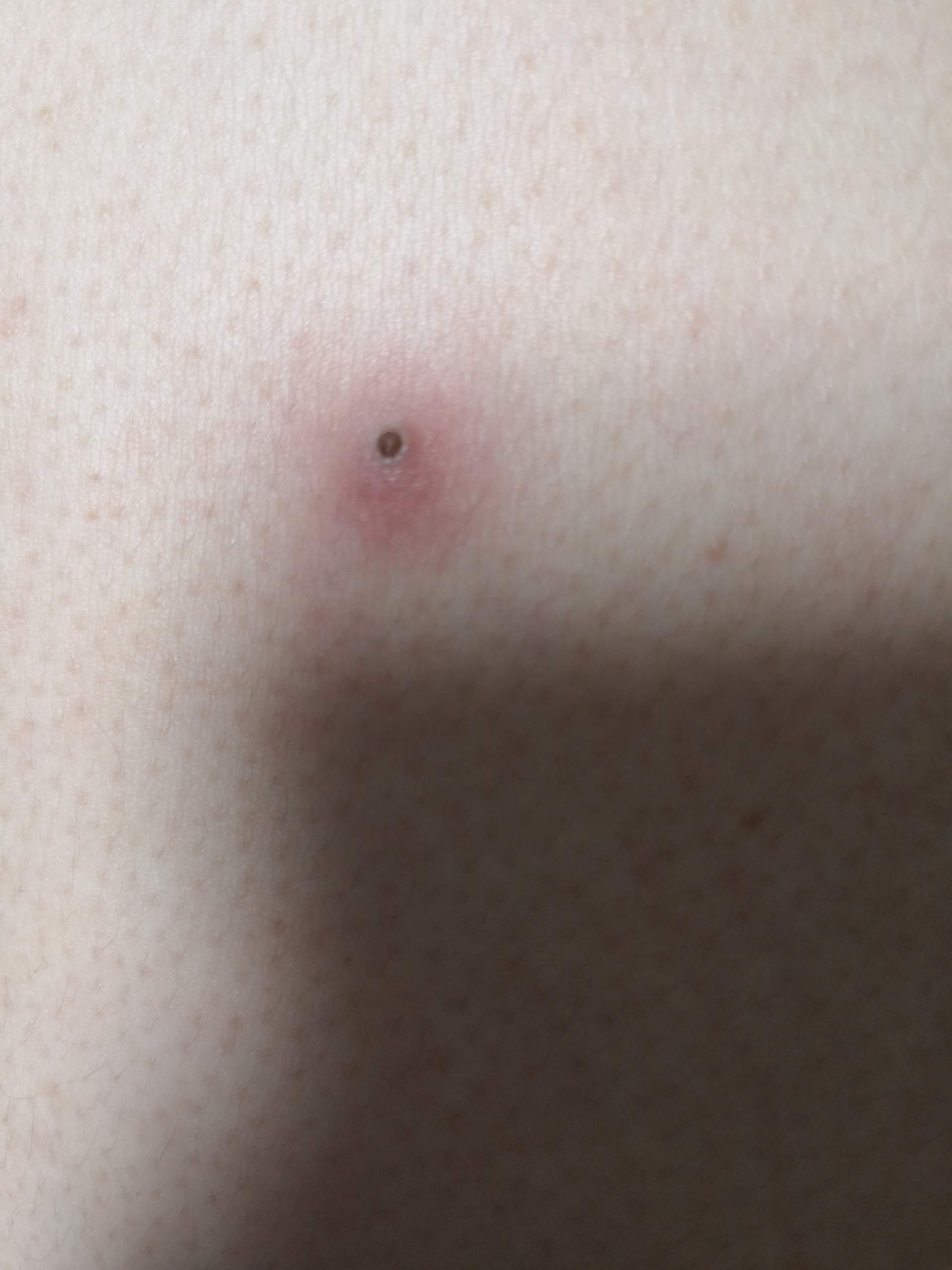 pickel auf rücken pickel auf rücken