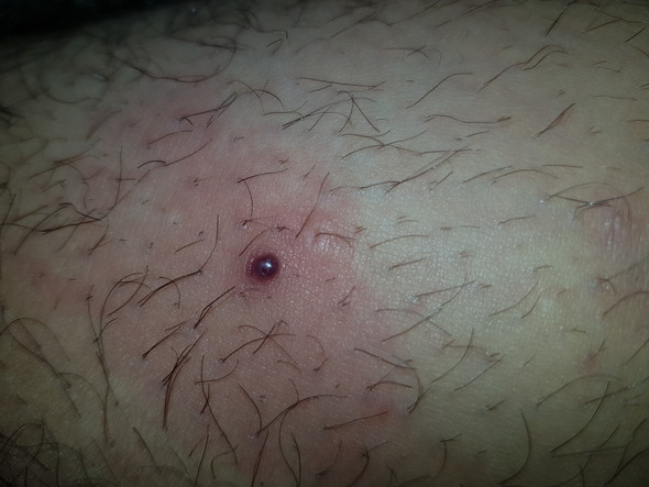 Schwarzer Pickel Im Oberschenkel Gesundheit Und Medizin Gesundheit Schmerzen Schwarzer Pickel Im Oberschenkel Gesundheit Und Medizin Gesundheit Schmerzen