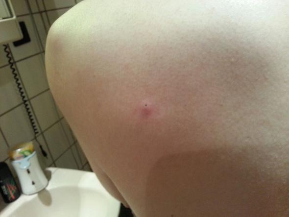 Schwarzer Punkt Auf Dem Rucken Gesundheit Haut Pickel Schwarzer Punkt Auf Dem Rucken Gesundheit Haut Pickel